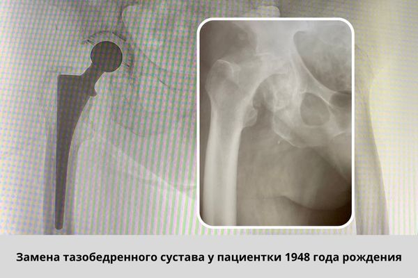 замена тазобедренного сустава у пациентки 1948 года рождения